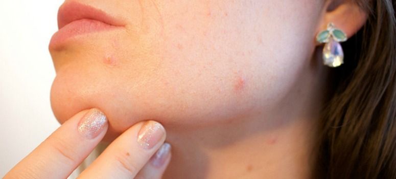 El acné, ¿ ventaja para los que lo sufren?