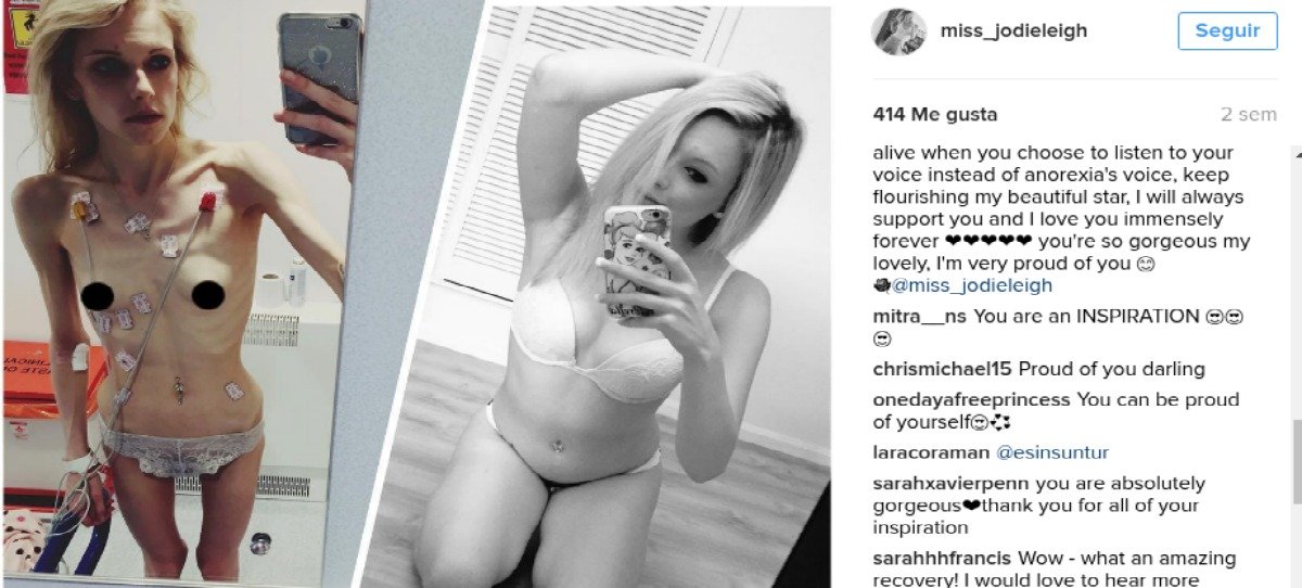Impactantes imágenes de una joven anoréxica que publica en Instagram su recuperación