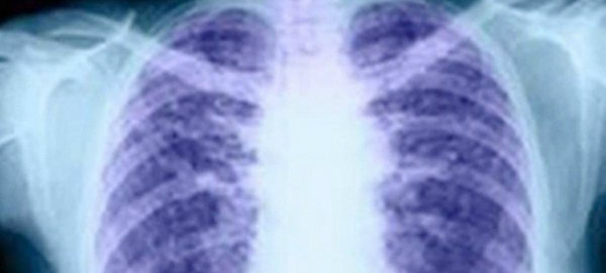 Nuevo descubrimiento que reduce el riesgo de progresión en cáncer de pulmón