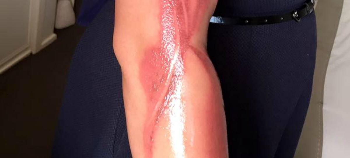 Una mujer sufre graves quemaduras por su iPhone 7