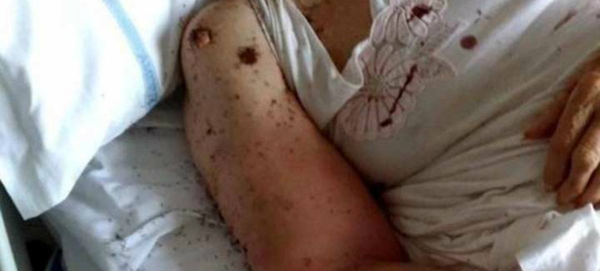 Indignación por una paciente rodeada de hormigas en un hospital de Italia