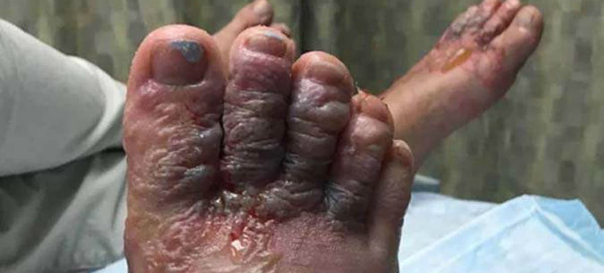 Imagen viral: Van de vacaciones a República Dominicana y terminan con los pies podridos
