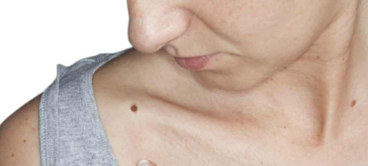 Prueban con éxito una nueva terapia contra el cáncer de piel