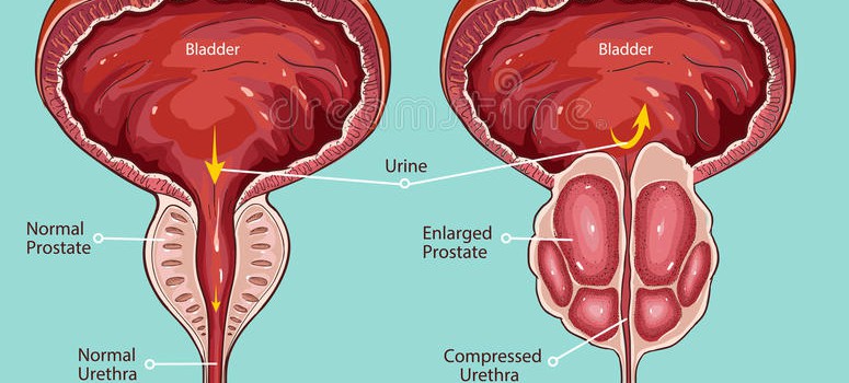 Cáncer de próstata: Las nuevas técnicas diagnósticas dan un vuelco al tumor